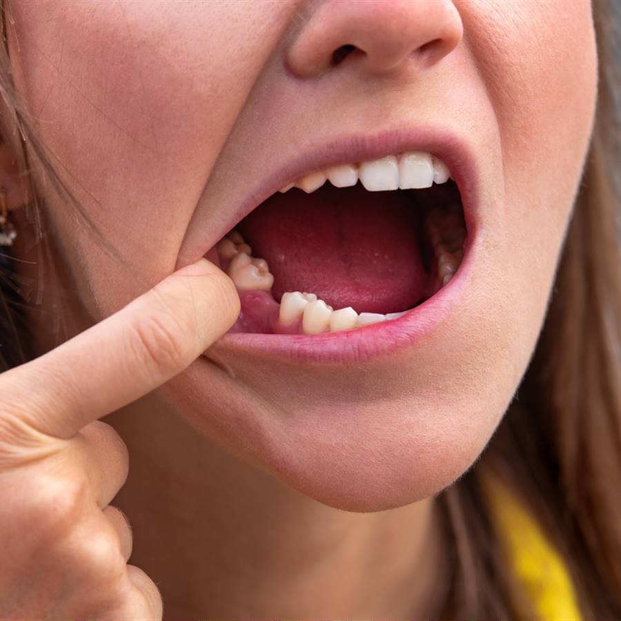 Agenesia dental: qué es el fenómeno que provoca que falten dientes