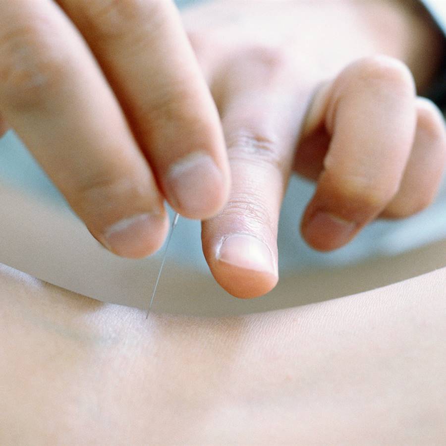 Acupuntura