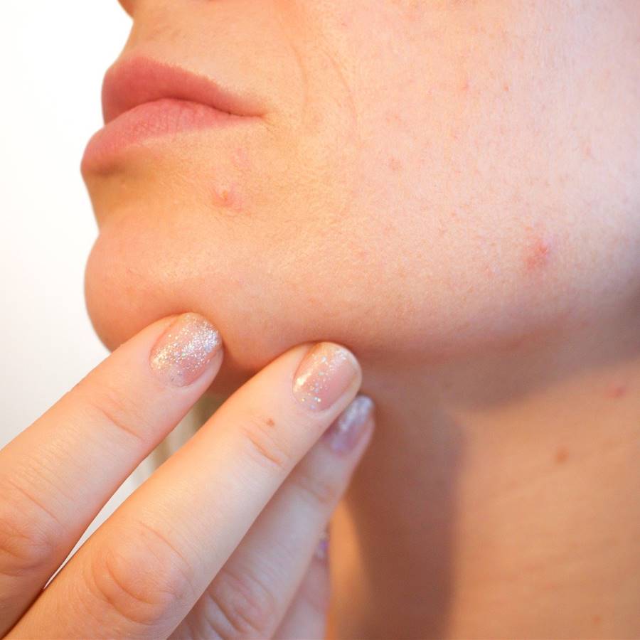 Cómo evitar y tratar el "maskne" (acné debido a la mascarilla)