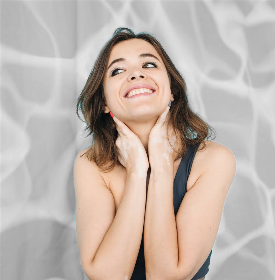 Vitiligo