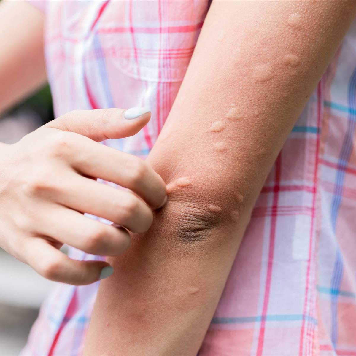 Urticaria por calor