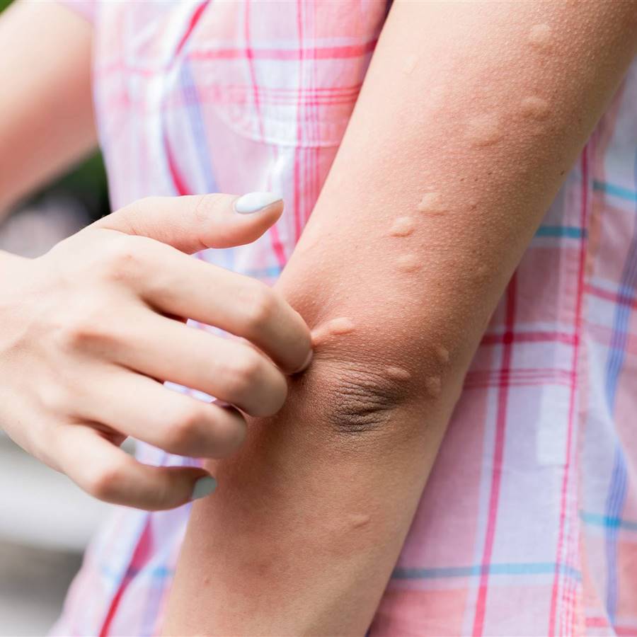 Urticaria por calor