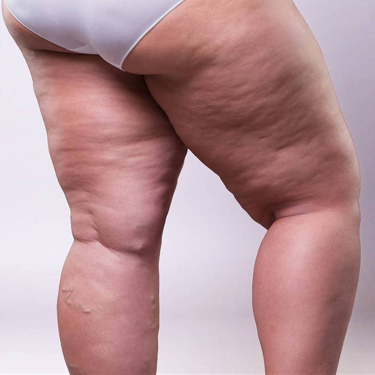 Lipedema Unimed BH: Diagnóstico y Tratamiento Integral para la Acumulación Anormal de Grasa 2025