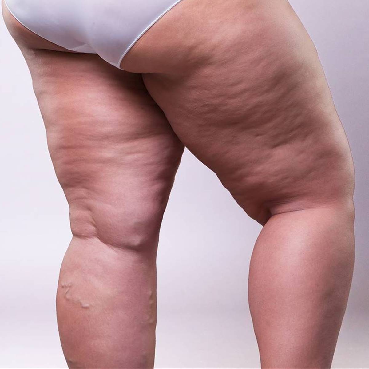 Lipedema: que es, síntomas, cómo identificar la enfermedad y cómo es su  tratamiento