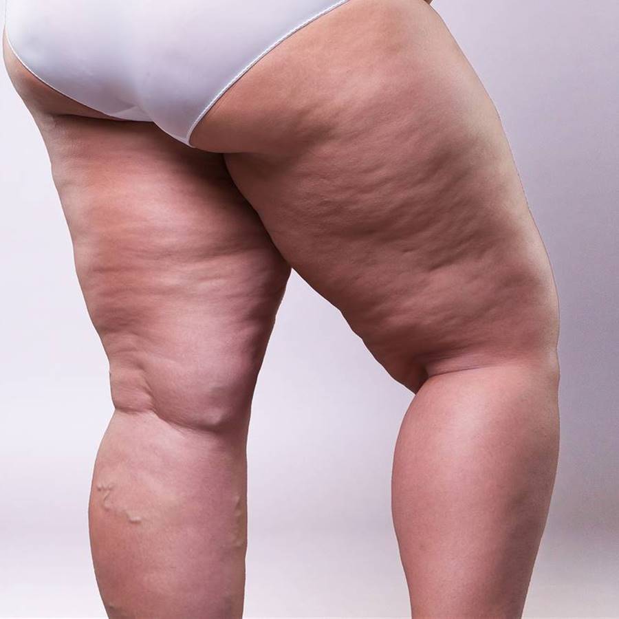 Lipedema: que es, síntomas, cómo identificar la enfermedad y cómo es su tratamiento