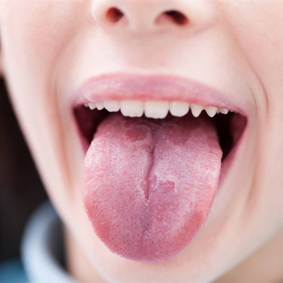 Lengua geográfica: tratamiento y causas de las manchas en la lengua 