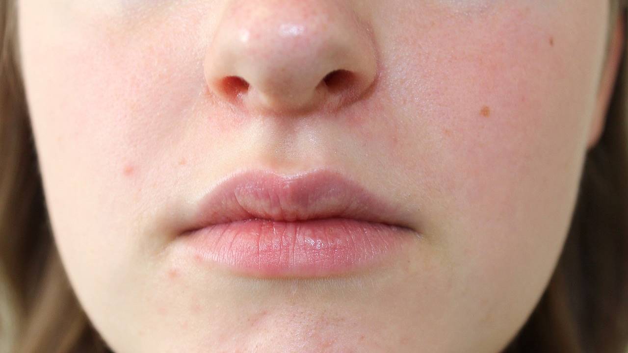 Dermatitis perioral