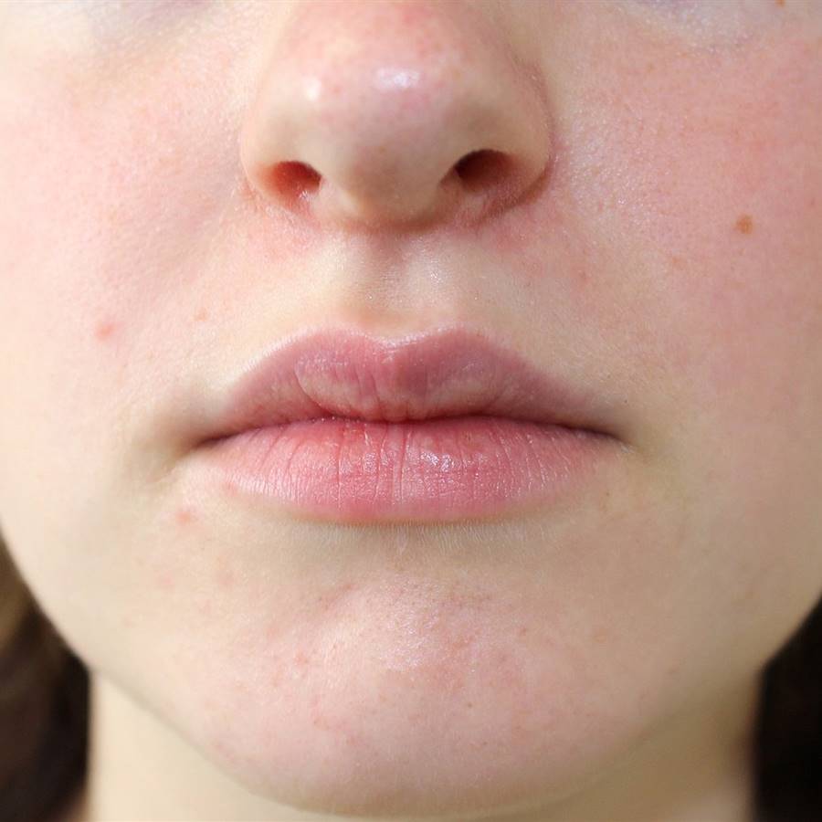 Dermatitis perioral: qué es y tratamiento natural