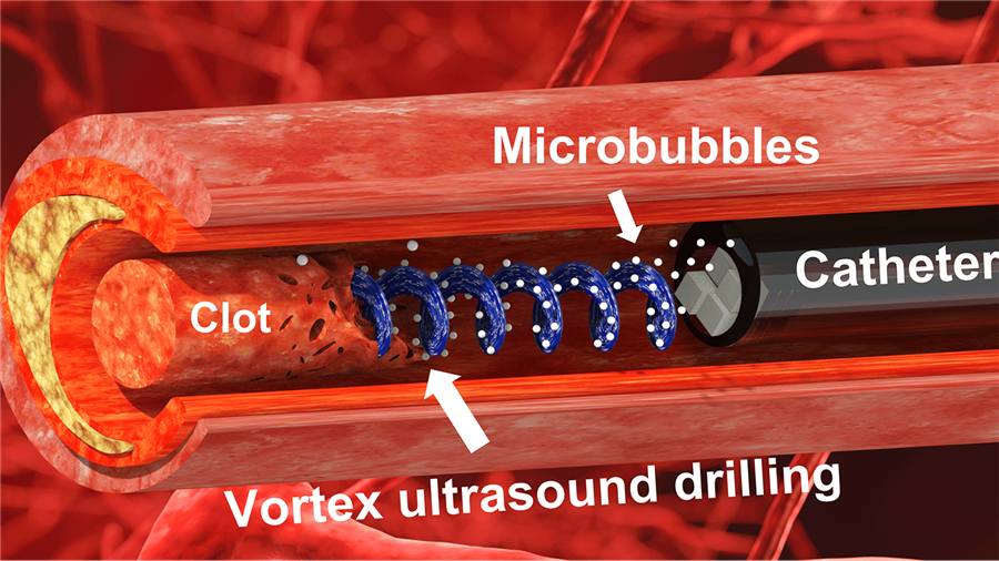 Ultrasonido de vórtice