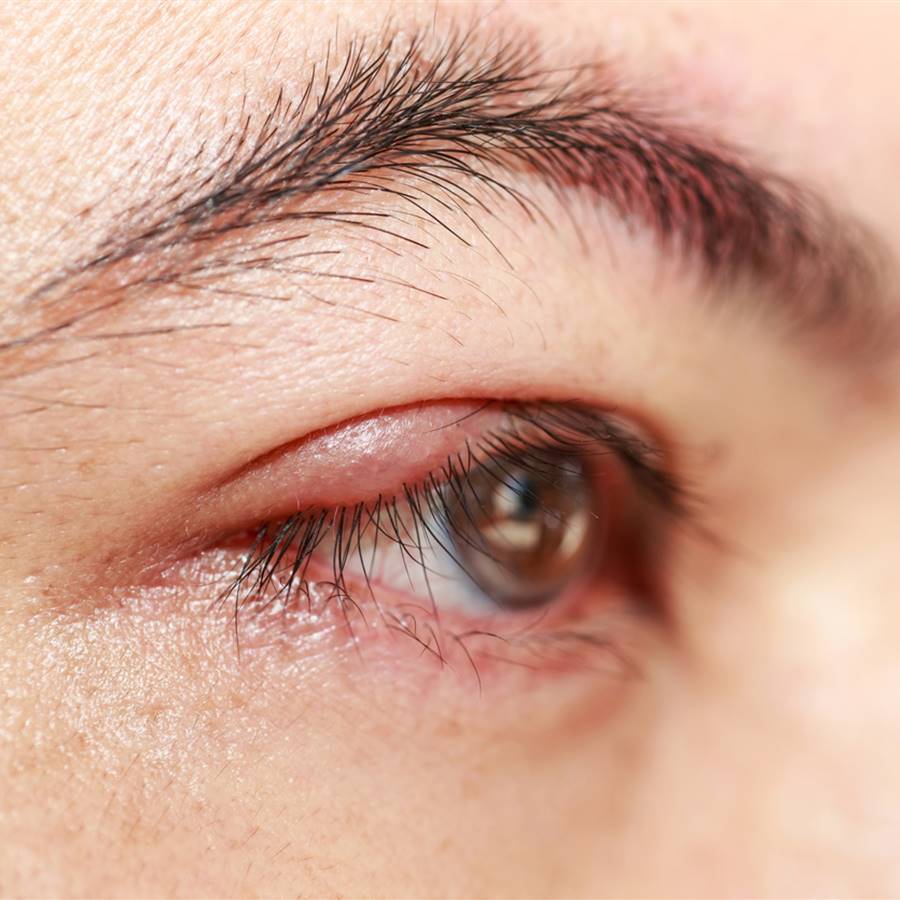 Por qué salen los orzuelos y cómo curarlos de forma rápida con remedios naturales