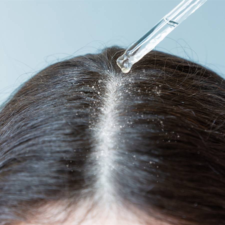 ¿Quitar la caspa en un día es posible? Cómo eliminarla con remedios naturales