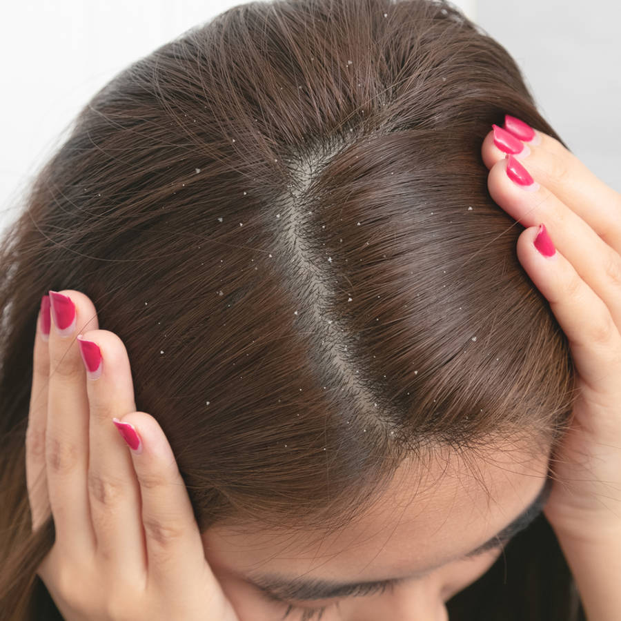 Caspa en el pelo: tipos de caspa y qué ayuda en cada caso