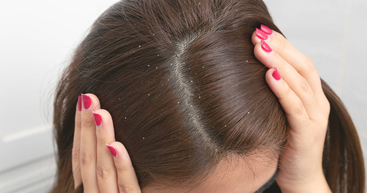 Caspa en el pelo: tipos de caspa y qué ayuda en cada caso