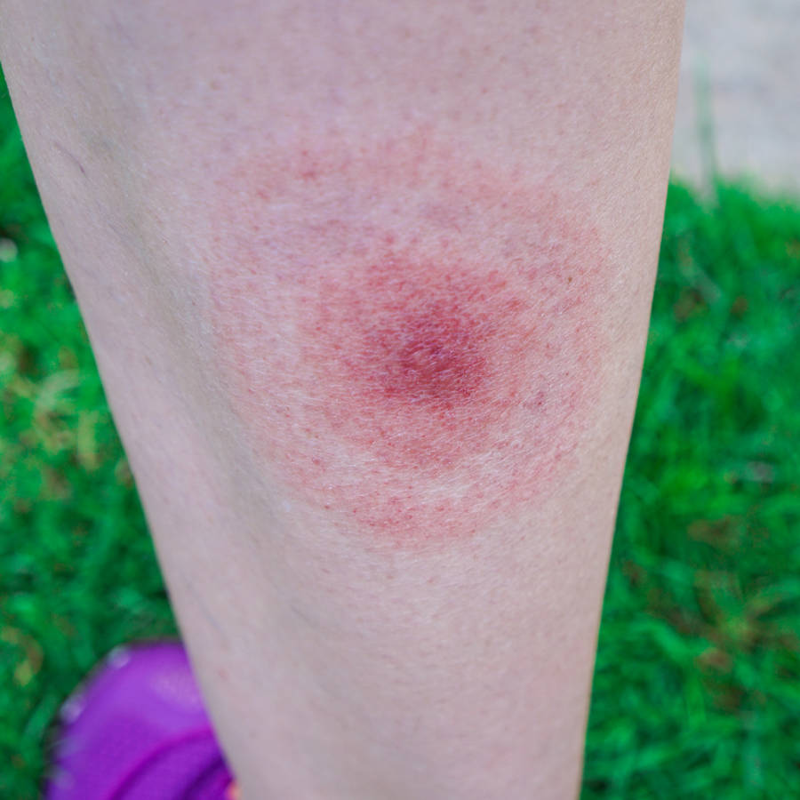 Enfermedad de Lyme (picadura de garrapata)