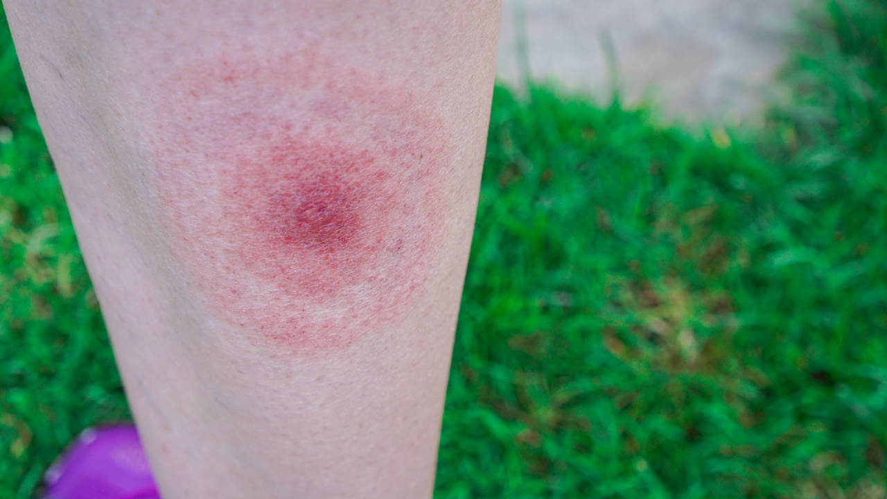 Enfermedad de Lyme (picadura de garrapata)