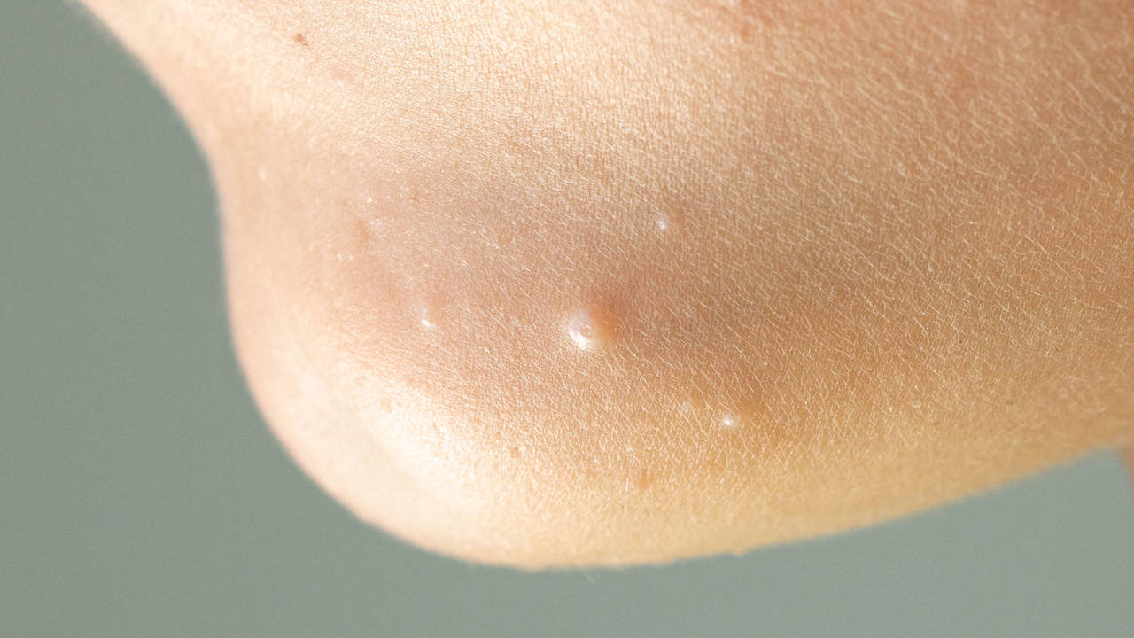 Moluscos en la piel (Moluscum contagiosum)
