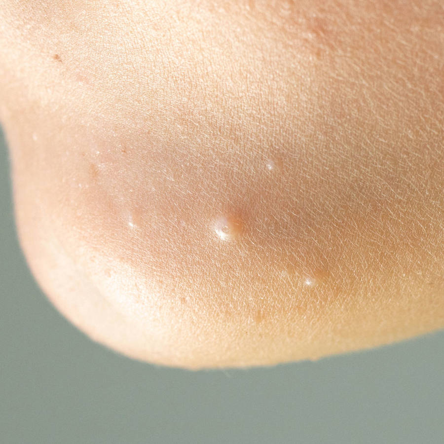 Moluscos en la piel: cómo quitarlos con remedios naturales