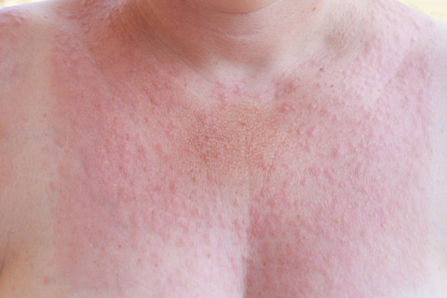 Alergia al sol granitos fotos