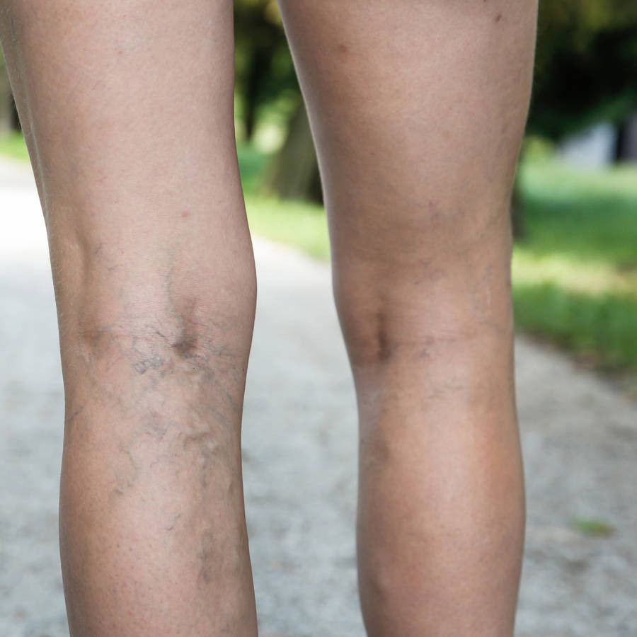 Varices en las piernas: tratamiento natural que ayuda a aliviar los síntomas