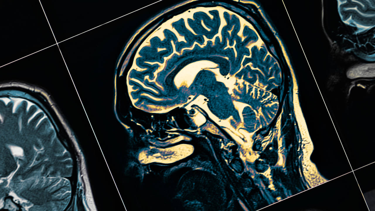 Día Mundial del Alzheimer: qué es y cómo comienza (lo último que se sabe)
