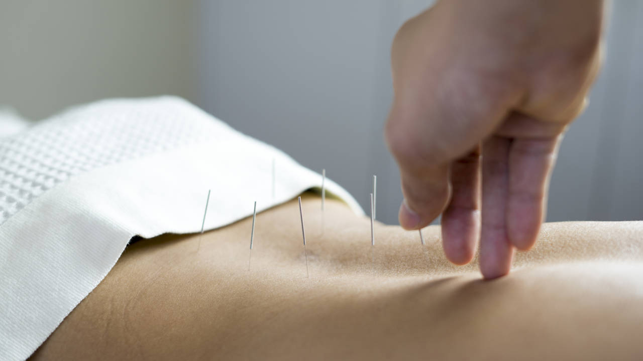 acupuntura tradicional