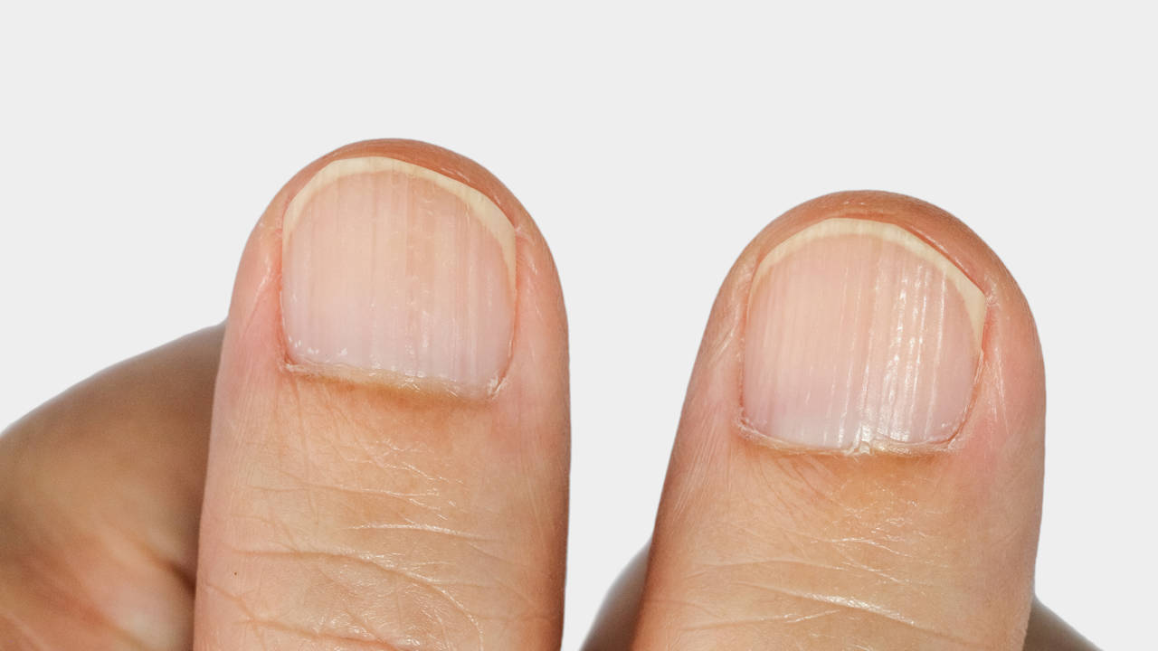 rayas verticales en las uñas delas manos
