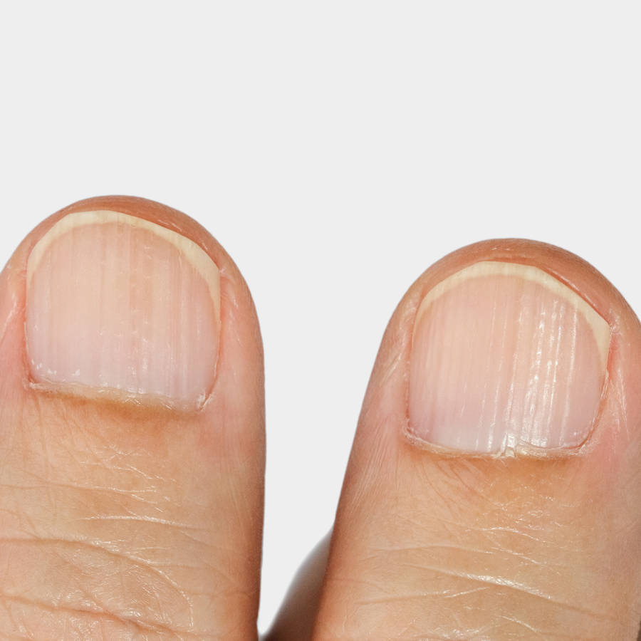 Uñas con rayas y líneas: causas y significados