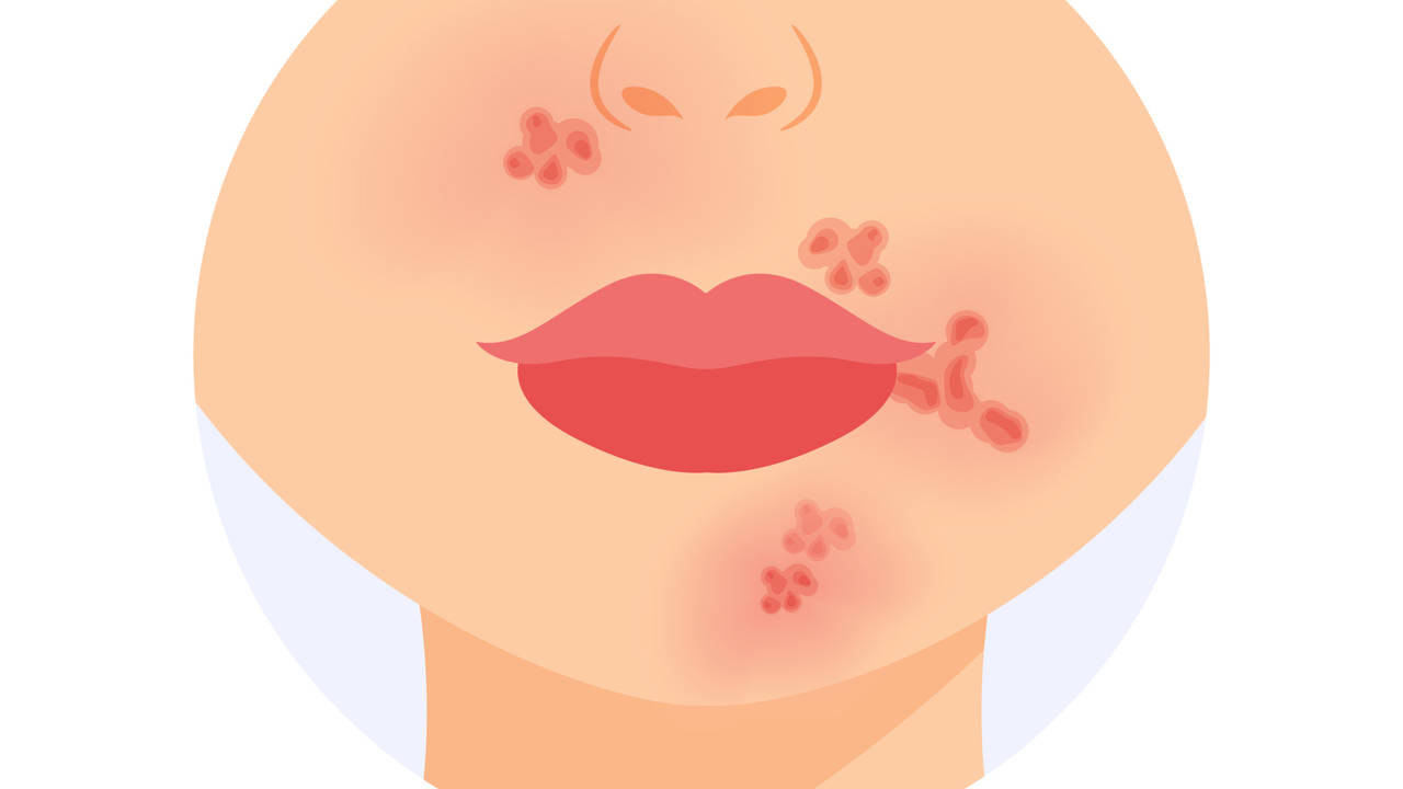 impetigo