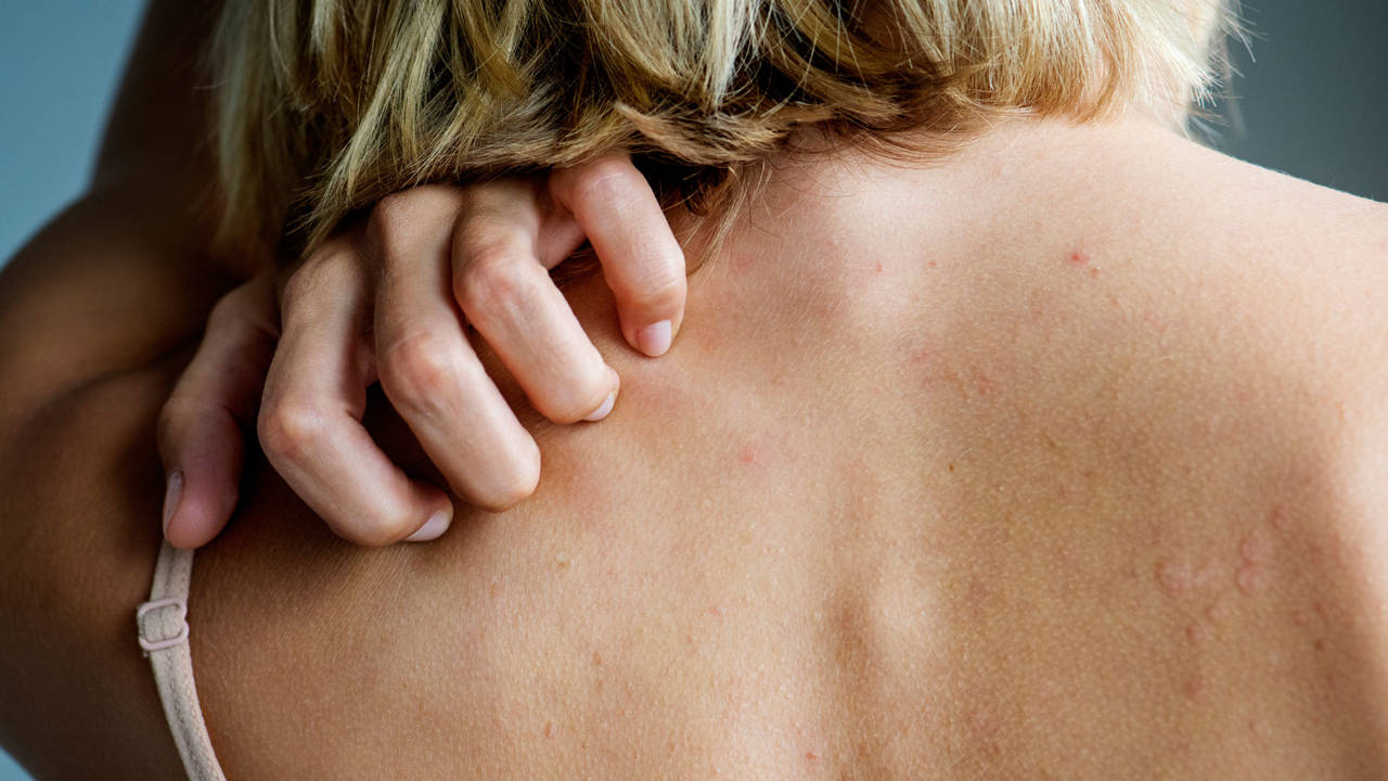 Petequias: qué son y por qué aparecen estas manchas rojas en la piel