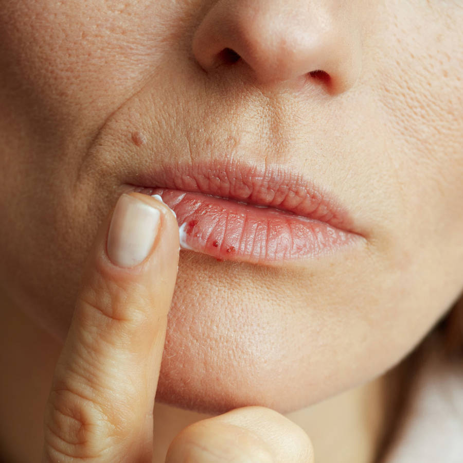 Calentura labial: cómo quitarla rápidamente con remedios naturales