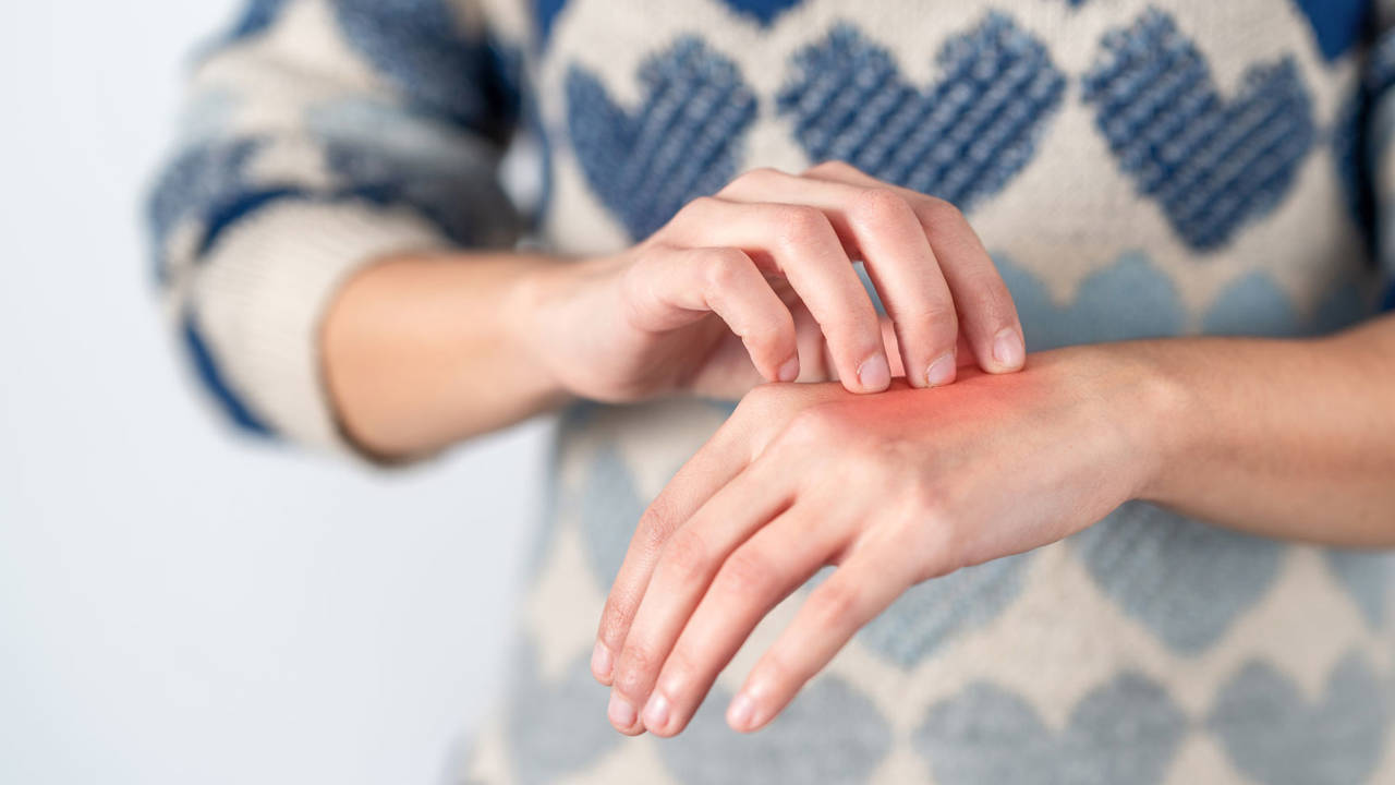dermatitis en las manos
